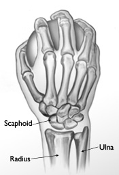 QrNXp_scaphoidfracture1573513.jpg